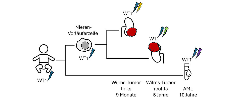 Bei einem Kind mit einer genetischen Veranlagung zum Wilms-Tumor trugen alle Körperzellen bereits eine mutierte Kopie des WT1-Gens. In der linken Niere bildete sich im Alter von 9 Monaten ein Wilms-Tumor, auf der rechten Seite entstand Jahre später ein weiterer Tumor. Mit 10 Jahren erkrankte das Kind schließlich an einer ebenfalls durch die WT1-Mutation ausgelösten akuten myeloischen Leukämie. 